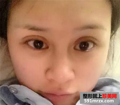 双眼皮加隆鼻溶脂针效果恢复过程