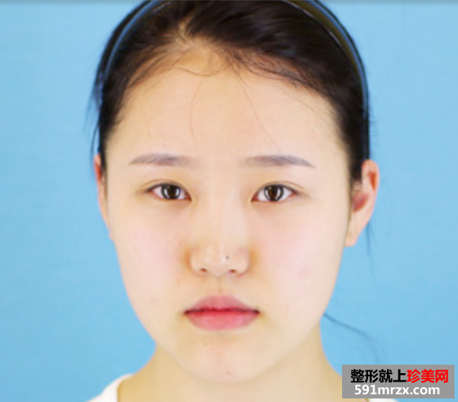 瘦脸针和假体隆鼻效果恢复案例图