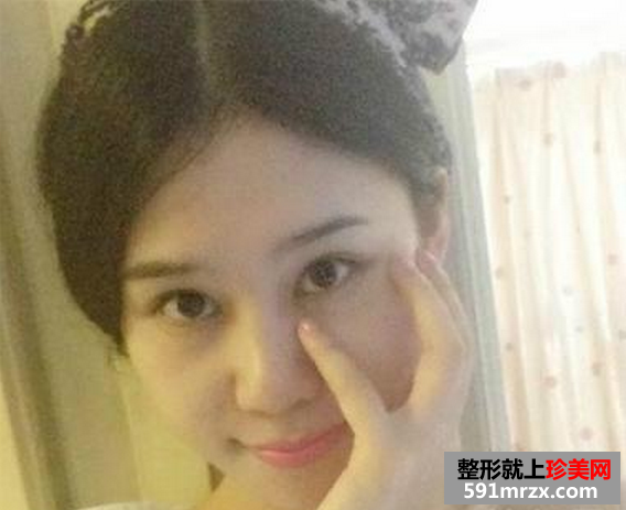 假体隆鼻效果恢复过程