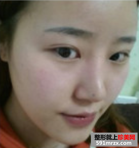 瘦脸针和假体隆鼻效果恢复案例图