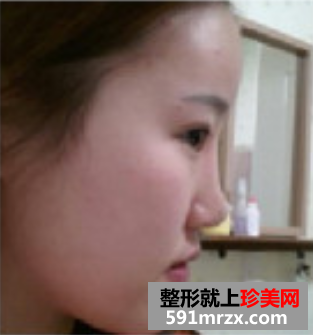 瘦脸针和假体隆鼻效果恢复案例图