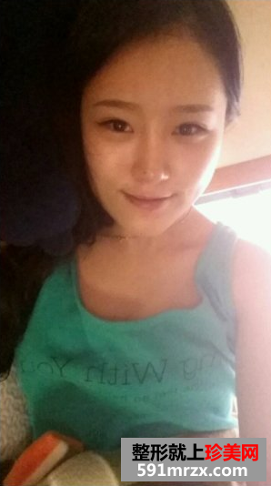 瘦脸针和假体隆鼻效果恢复案例图