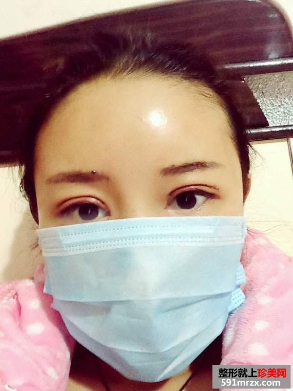 自体脂肪填充和双眼皮效果恢复案例图
