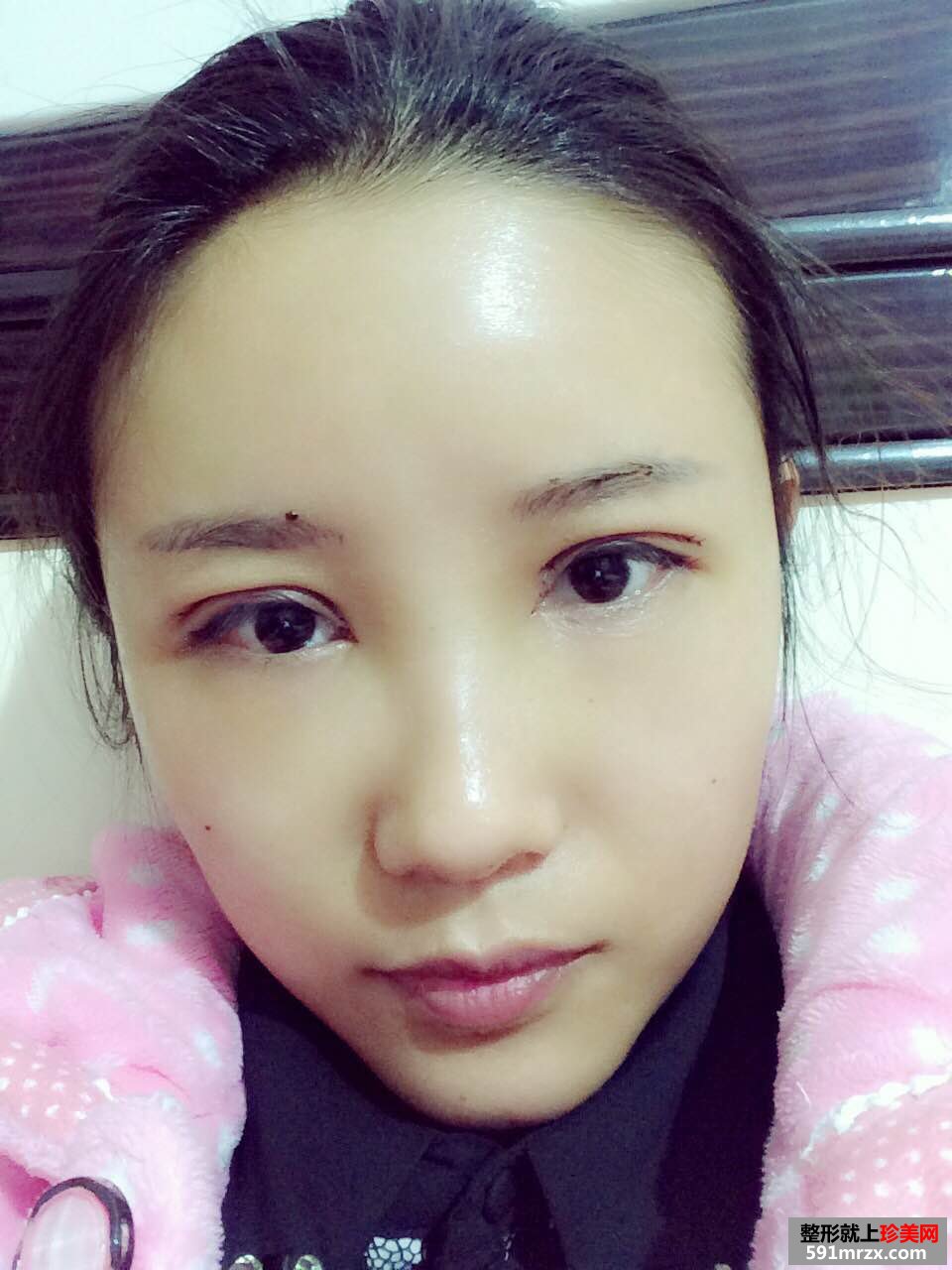 自体脂肪填充和双眼皮效果恢复案例图