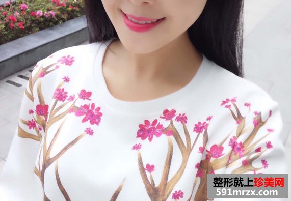 自体脂肪丰下巴效果恢复案例图