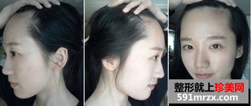 发际线种植手术前后效果对比图和恢复过程