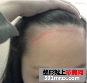 发际线种植手术前后效果对比图和恢复过程