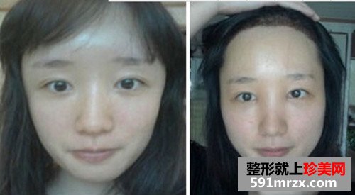 发际线种植手术前后效果对比图和恢复过程