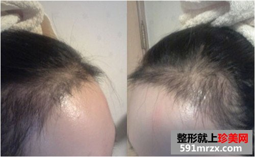 发际线种植手术前后效果对比图和恢复过程