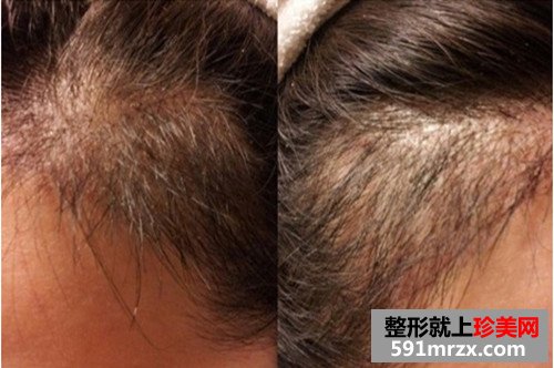 发际线种植手术前后效果对比图和恢复过程