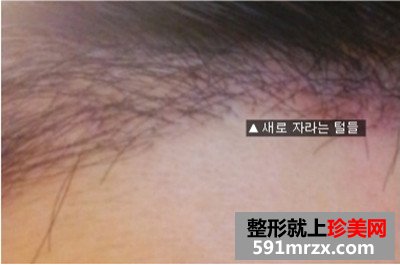 发际线种植手术前后效果对比图和恢复过程