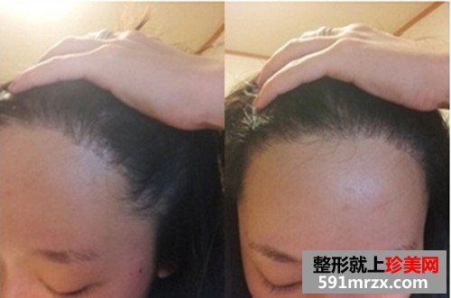 发际线种植手术前后效果对比图和恢复过程