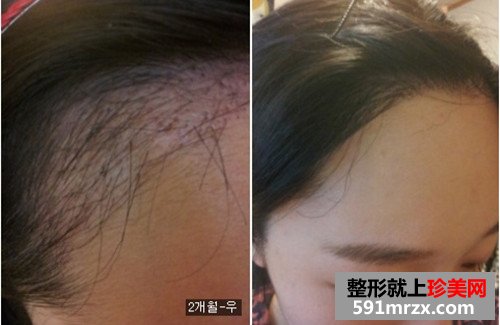 发际线种植手术前后效果对比图和恢复过程