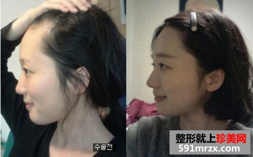 发际线种植手术前后效果对比图和恢复过程