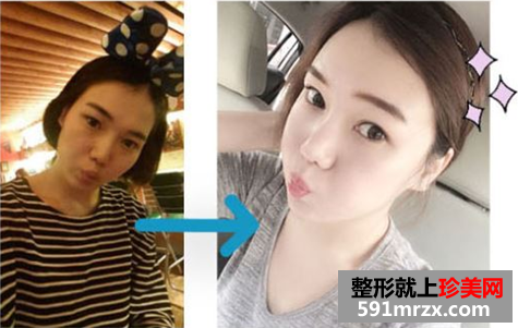 无痕芭比双眼皮手术前后对比效果图片和恢复过程