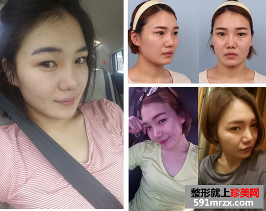 无痕芭比双眼皮手术前后对比效果图片和恢复过程