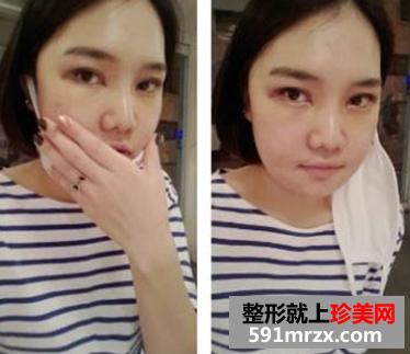 无痕芭比双眼皮手术前后对比效果图片和恢复过程