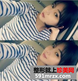 无痕芭比双眼皮手术前后对比效果图片和恢复过程