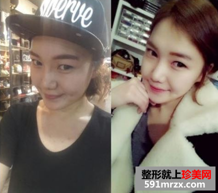 无痕芭比双眼皮手术前后对比效果图片和恢复过程