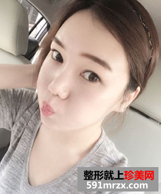 无痕芭比双眼皮手术前后对比效果图片和恢复过程