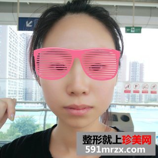 打瘦脸针除咬肌前后效果对比图和恢复过程
