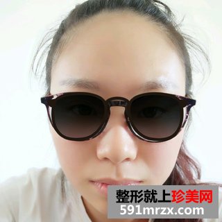 打瘦脸针除咬肌前后效果对比图和恢复过程