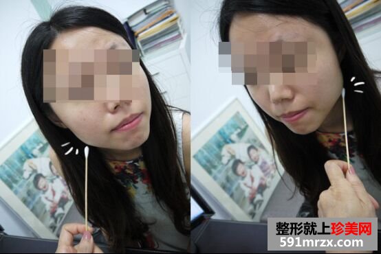 咬肌巨大最终选择注射瘦脸