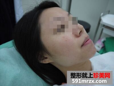 咬肌巨大最终选择注射瘦脸