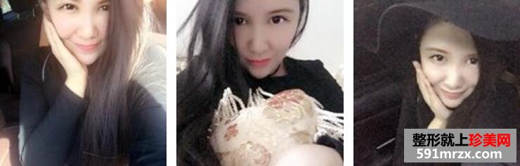 面部精细吸脂瘦脸前后效果对比图和恢复过程