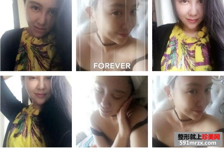 面部精细吸脂瘦脸前后效果对比图和恢复过程