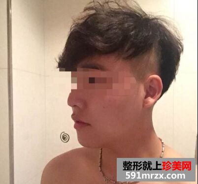 下巴后缩不好看 男生也做硅胶假体垫下巴