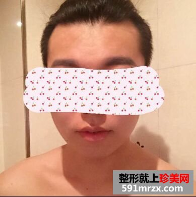 下巴后缩不好看 男生也做硅胶假体垫下巴