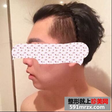 下巴后缩不好看 男生也做硅胶假体垫下巴