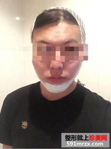 下巴后缩不好看 男生也做硅胶假体垫下巴