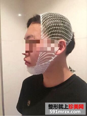 下巴后缩不好看 男生也做硅胶假体垫下巴