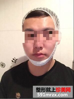 下巴后缩不好看 男生也做硅胶假体垫下巴