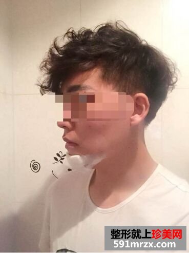 下巴后缩不好看 男生也做硅胶假体垫下巴