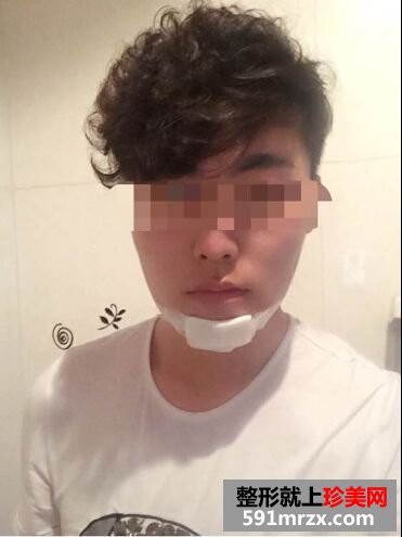 下巴后缩不好看 男生也做硅胶假体垫下巴