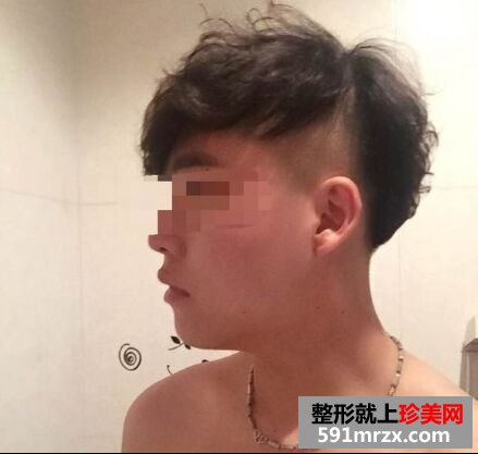 下巴后缩不好看 男生也做硅胶假体垫下巴