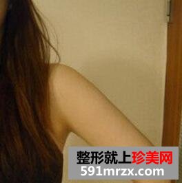 水动力吸脂瘦手臂案例效果图