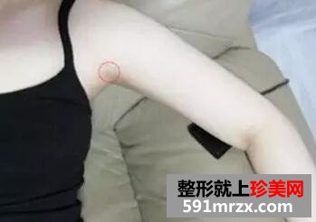 水动力吸脂瘦手臂案例效果图