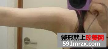 水动力吸脂瘦手臂案例效果图