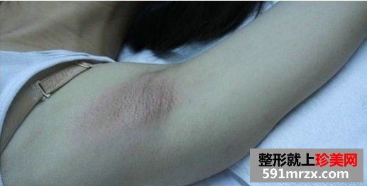 冰点激光永久脱腋毛恢复过程照片与经验分享