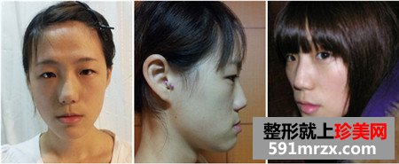 立体轮廓+贵族手术前后对比照片和恢复效果