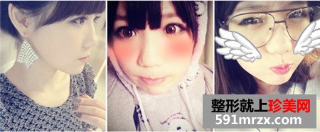立体轮廓+贵族手术前后对比照片和恢复效果