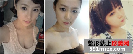 立体轮廓+贵族手术前后对比照片和恢复效果