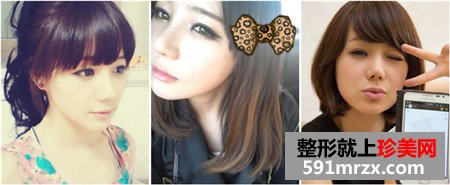 立体轮廓+贵族手术前后对比照片和恢复效果