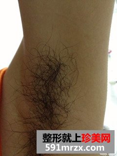 激光脱腋毛有副作用吗？看看我的前后对比图和恢复过程吧！