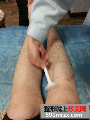 激光脱腿毛好吗？看看我的前后对比效果图片和恢复过程就知道啦！