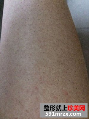 激光脱腿毛好吗？看看我的前后对比效果图片和恢复过程就知道啦！
